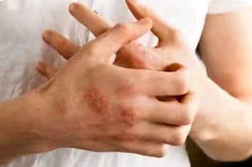 Bukan Alergi Biasa, Simak Tips dan Perawatan yang Tepat untuk Penderita Eksim