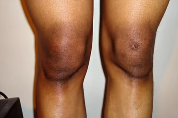 Kulit Lutut Gelap Bikin Nggak Percaya Diri? Ini Cara Mengatasinya Agar Tampak Lebih Cerah