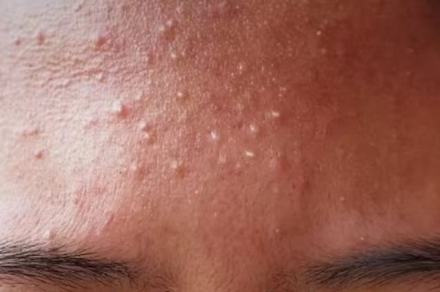 Cegah Berkembang Jadi Jerawat, Simak! Cara Cegah Bruntusan di Wajah