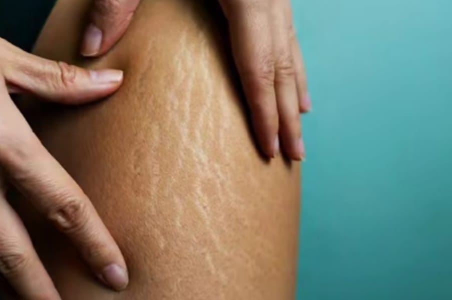 Benarkah Stretch Mark Tidak Bisa Dihilangkan?, Ini Fakta, Perawatan, dan Cara Mencegahnya