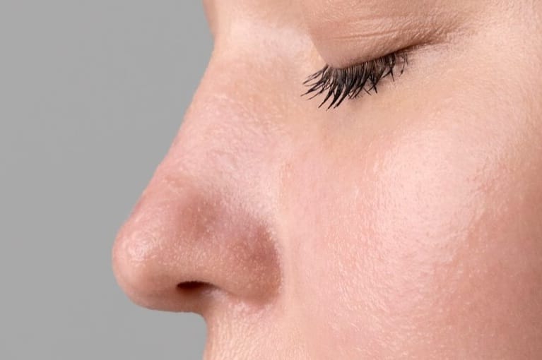 Kulit Hidung Kering dan Mengelupas Bikin Nggak Nyaman? Ini Cara Mengatasinya